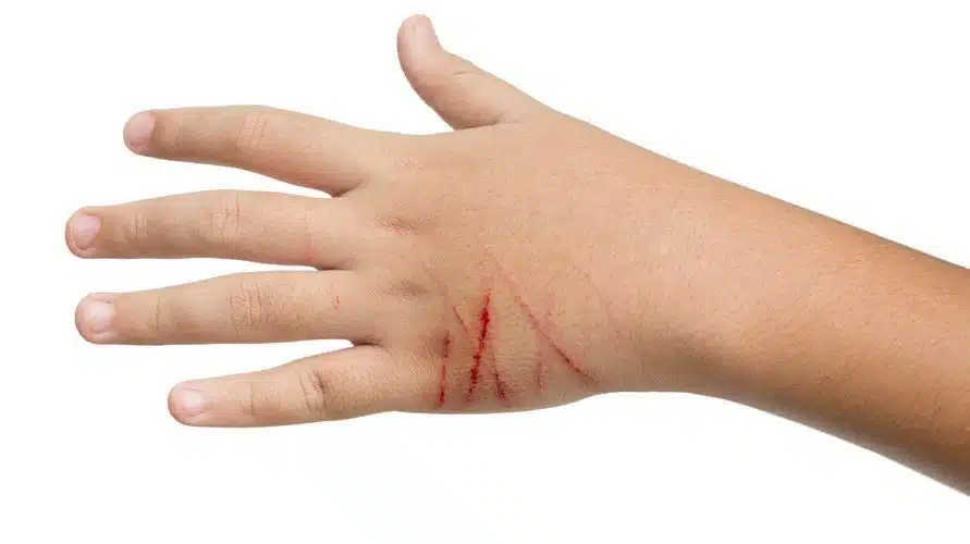 Cara Menyembuhkan Gigitan Kucing